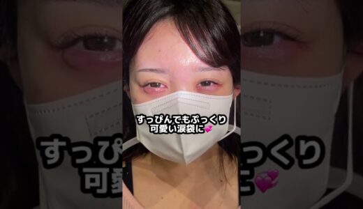 【涙袋ヒアルロン酸】Ranzukiモデルの山本姫香ちゃん担当させていただきました★ #shorts