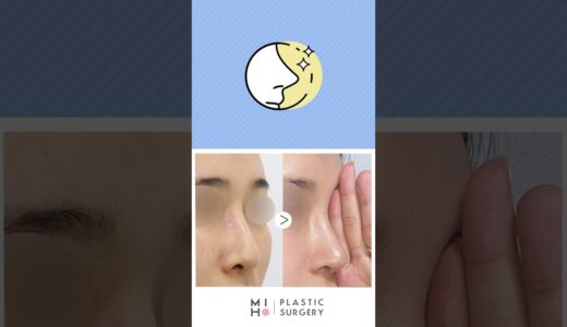 韓国美容整形外科,鼻整形,初手術,再手術,自然な鼻手術,症例写真,整形,美容外科,韓国