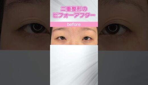 【二重整形】共立美容外科 新垣先生の症例カタログ【埋没・切開】 #shorts