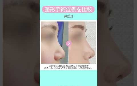 韓国美容整形外科,鼻成形,初手術,再手術,自然な鼻手術,症例写真