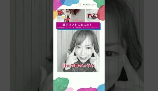 〈美容整形レビュー：カウンセリング編〉眉下リフト整形　#美容整形 #眉下切開 #東京美容クリニック