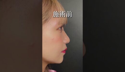【鼻整形】ギャルアイドルが鼻整形に挑戦　#shorts