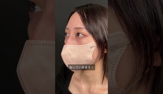 【クマ取り】美女のクマ取り大公開！#美容整形 #美容外科 #美容クリニック #美容 #クマ取り