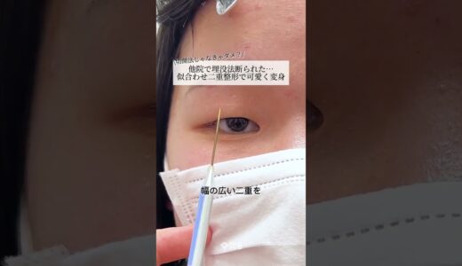 【二重整形】他院で埋没法を断られた患者様🥺埋没法で可愛くなりました✨#shorts