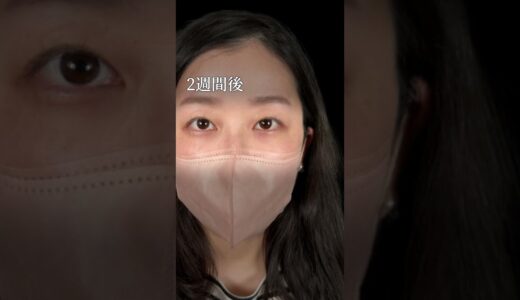 【クマ取り】暗いお目元を改善！！#美容整形 #美容外科 #美容クリニック #美容 #整形 #クマ取り