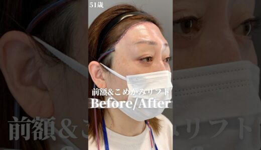 前額こめかみで一石三鳥✨ #美容整形