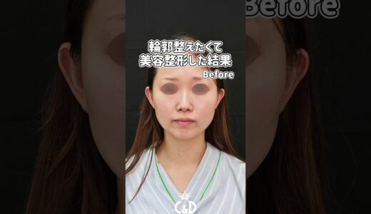 輪郭整えたくて美容整形した結果 #美容 #整形