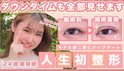 【二重整形】二重のダウンタイムも全て見せます【二重になる方法】埋没/目頭切開ダウンタイムの事がわかる！【クイックコスメティークダブル】#湘南美容クリニック