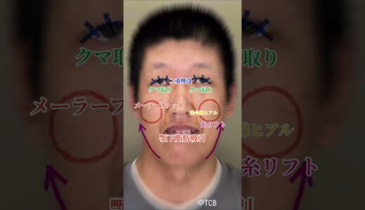 【糸リフト】フル整形でどこまで変わる？#shorts
