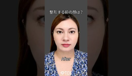 【糸リフト】整形する前の顔を振り返る❗️#shorts