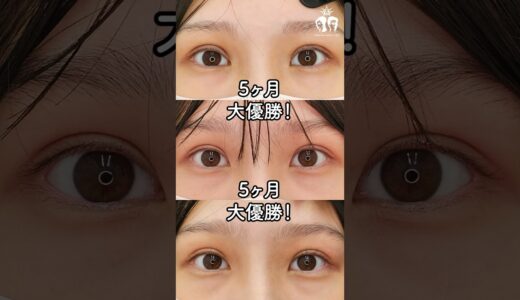 取れない二重を切開でつくるよ！！#美容 #美容整形 #垢抜け #shorts