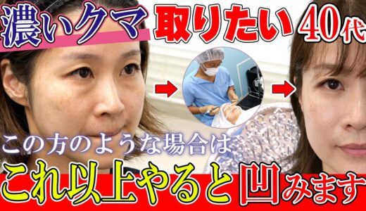 【やってはいけない目の下のクマ取り整形】欲張りすぎると凹みます。本当にゴッソリ行きますか？【脂肪注入でシワとタルミ感を予防】湘南美容クリニック