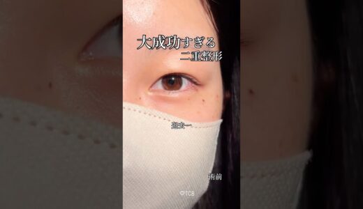 【二重整形】過去一のポテンシャル😳美女が爆美女に✨#shorts