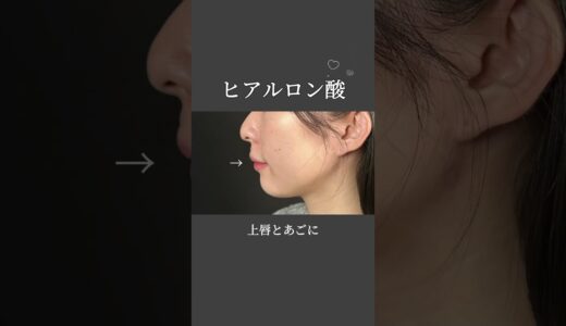 【ヒアルロン酸】横顔を美しく整える！#美容外科 #美容整形 #美容クリニック #整形