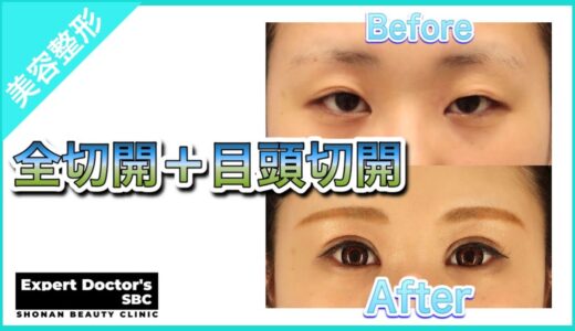 【全切開＋目頭切開】ビフォーアフター【美容整形】
