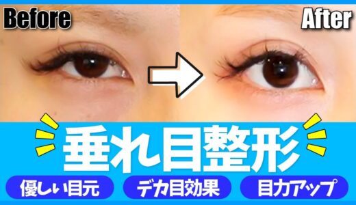 【たれ目整形】整形バレせず大きな目元に！垂れ目整形術のビフォーアフターをご紹介！