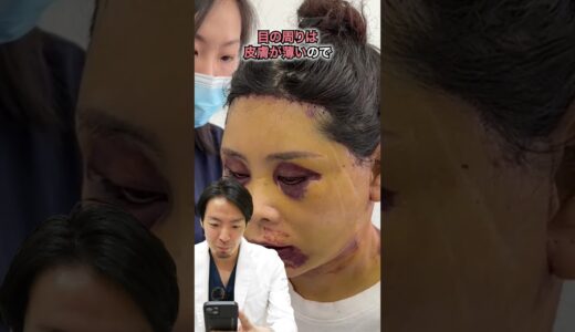 【美容整形】これって失敗？衝撃のダウンタイム！！ #shorts