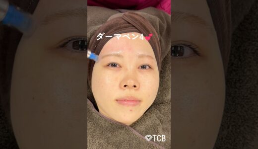 【ダーマペン】肌治療で効果的なのは🤔？ #shorts #ダーマペン #美容整形 #整形 #TCB