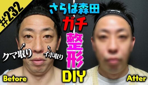 【さらば森田 ガチ整形DIY】クマ&イボ除去で大変身！！