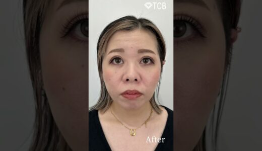 【二重整形】若返り整形した結果…🥹#shrots