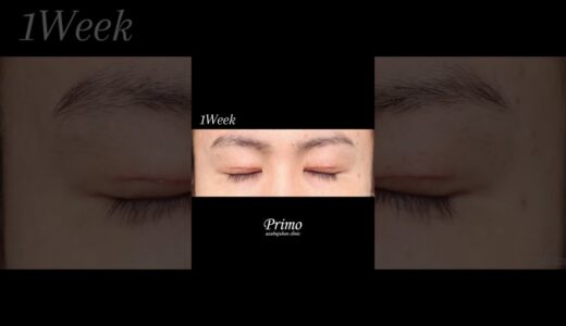 二重　下垂　目　整形　美容整形　#shorts