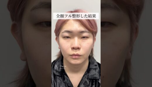【全顔整形】衝撃の結果！#shorts