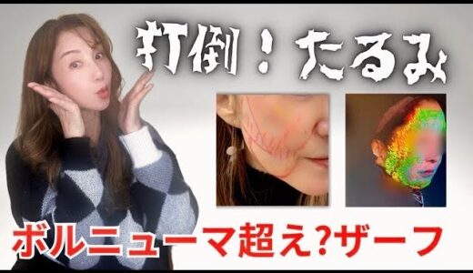【たるみ治療】高周波治療💡❤️‍🩹色々受けて今回はnew施術ザーフのレビュー動画です🌟【ザーフ】