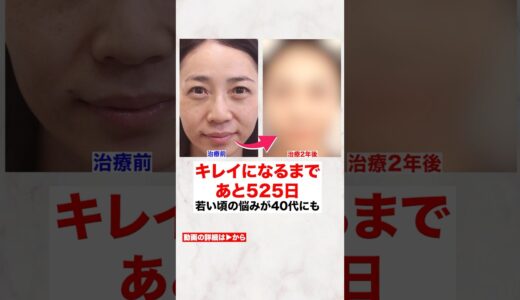 「目のシワがなくなった」人生を変えた再生医療 #美容整形  #アンチエイジング #肌の再生医療