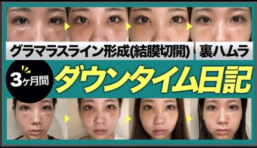 【美容整形】ダウンタイム経過も大公開!!タレ目形成・裏ハムラ３ヶ月密着