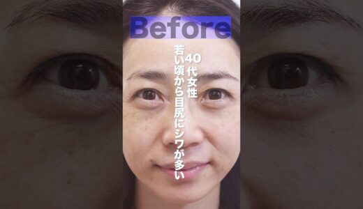 【目尻美人】整形に抵抗を持つアラフィフの再生医療に密着 #エイジングケア #美容整形  #肌の再生医療