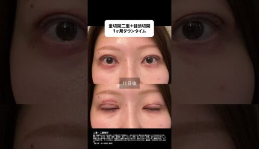 全切開&目頭切開 ダウンタイム大公開#美容 #美容整形 #二重切開 #二重 #整形 #ダウンタイム
