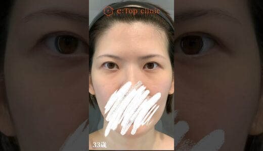 前額リフトと目頭切開症例🌟#美容整形