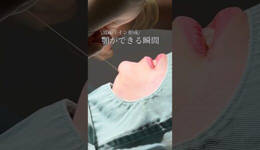【小顔整形】3DEライン形成　顎ができる瞬間#shorts