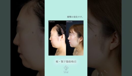 脂肪吸引で若返る。頬のたるみも解消！ #美容 #美容整形 #美容外科 #脂肪吸引