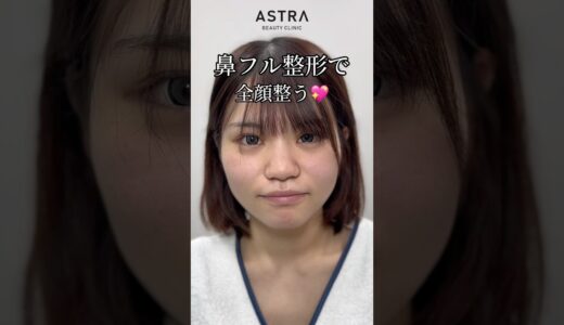 鼻フル整形でお顔が整う🫢💖#astrabeautyclinic  #アストラビューティークリニック #塩満恵子 #鼻整形 #美容整形 #忘れ鼻