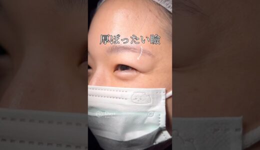 【二重整形】厚い瞼、衝撃の術後！#shorts