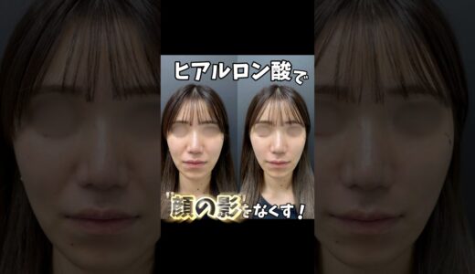 ヒアルロン酸で顔の影を無くす！#美容 #美容整形外科医 #美容整形 #バブみ院長 #美容皮膚科#貴族ヒアル#ヒアルロン酸#小顔