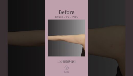 元々細い腕もさらに細く美しく。 #美容 #美容整形 #美容外科 #脂肪吸引