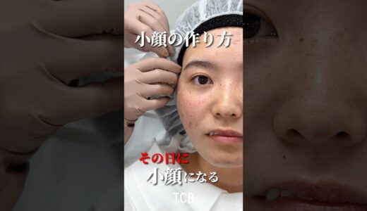 【糸リフト】小顔の作り方大公開#shorts