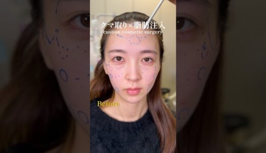 クマ取り×脂肪注入で垢抜け！#美容整形 #クマ取り #脂肪注入