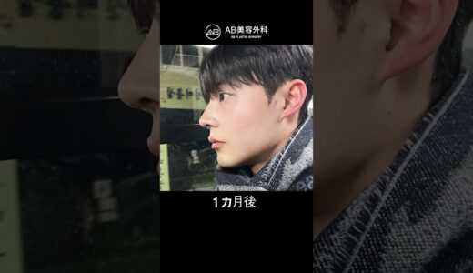 鼻整形後、さらにイケメンに！ | AB美容整形