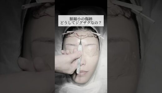 【整形】額縮小の傷跡どうしてジグザグなの？#shorts