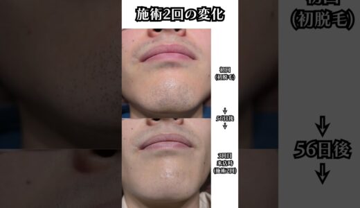 【光脱毛でもやり方次第で抜けます】