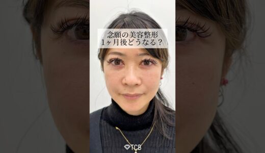 【クマ取り】念願の美容整形！1ヶ月後どうなる？🥺#shorts