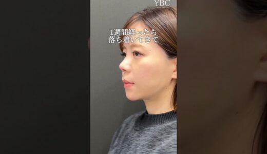 【鼻整形】念願の鼻整形した結果･･･#shorts