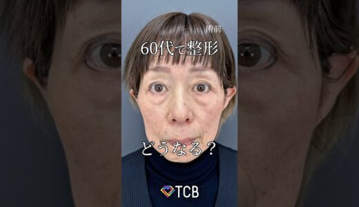 【クマ取り】60代で整形、どうなる？#shorts#目の下のクマ取り#目の下のたるみ取り#目の下のふくらみ取り#目の下のクマ#TCB