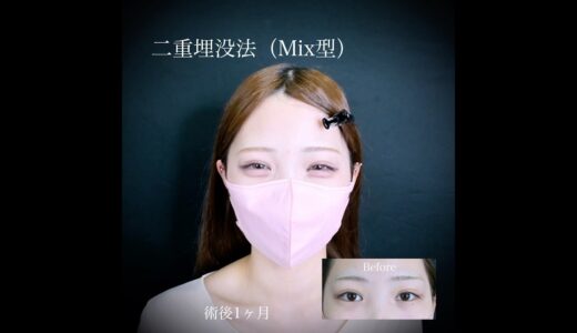可愛すぎる目元。人生激変！ #美容 #美容外科 #美容整形 #二重埋没