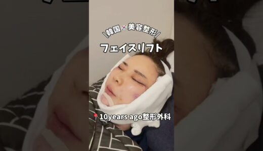 【韓国整形】フェイスリフトでどこまで若返れるか？ #美容 #整形 #美容整形#ダウンタイム経過
