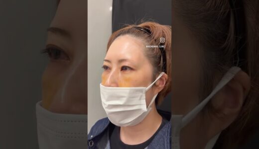 裏ハムラ #美容整形 #愛知県 #整形 #プチ整形 #整形前後