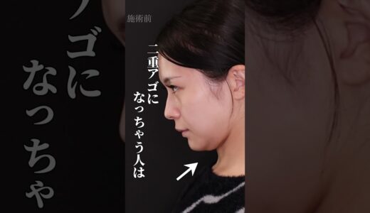 みんなは知らない、横顔美人の正体…… #美容整形